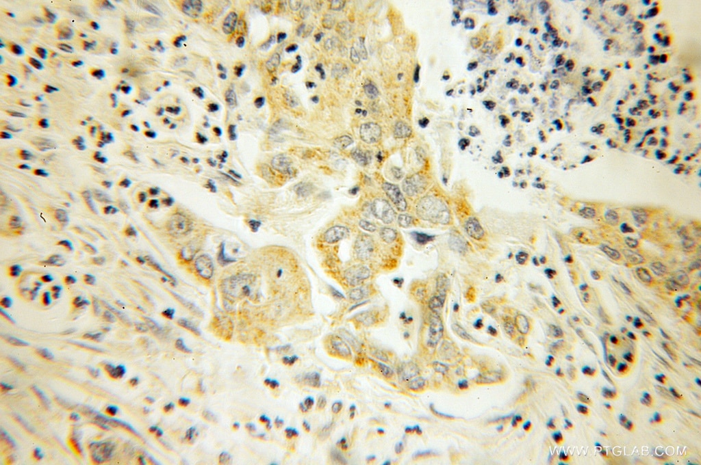 Immunohistochemistry (IHC) staining of human pancreas cancer tissue using TRX2 Polyclonal antibody (13089-1-AP)