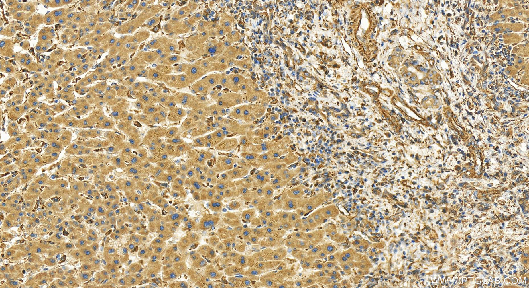 Immunohistochemistry (IHC) staining of human intrahepatic cholangiocarcinoma tissue using TXNDC11 Polyclonal antibody (25687-1-AP)