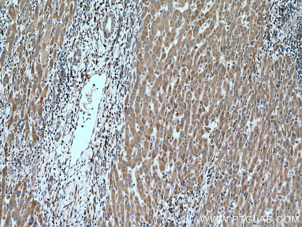 IHC staining of human liver cancer using 20181-1-AP