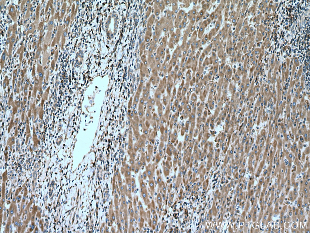 Immunohistochemistry (IHC) staining of human liver cancer tissue using ERp19 Polyclonal antibody (20181-1-AP)