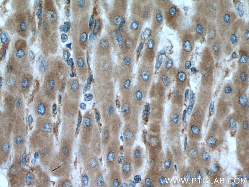Immunohistochemistry (IHC) staining of human liver cancer tissue using ERp19 Polyclonal antibody (20181-1-AP)
