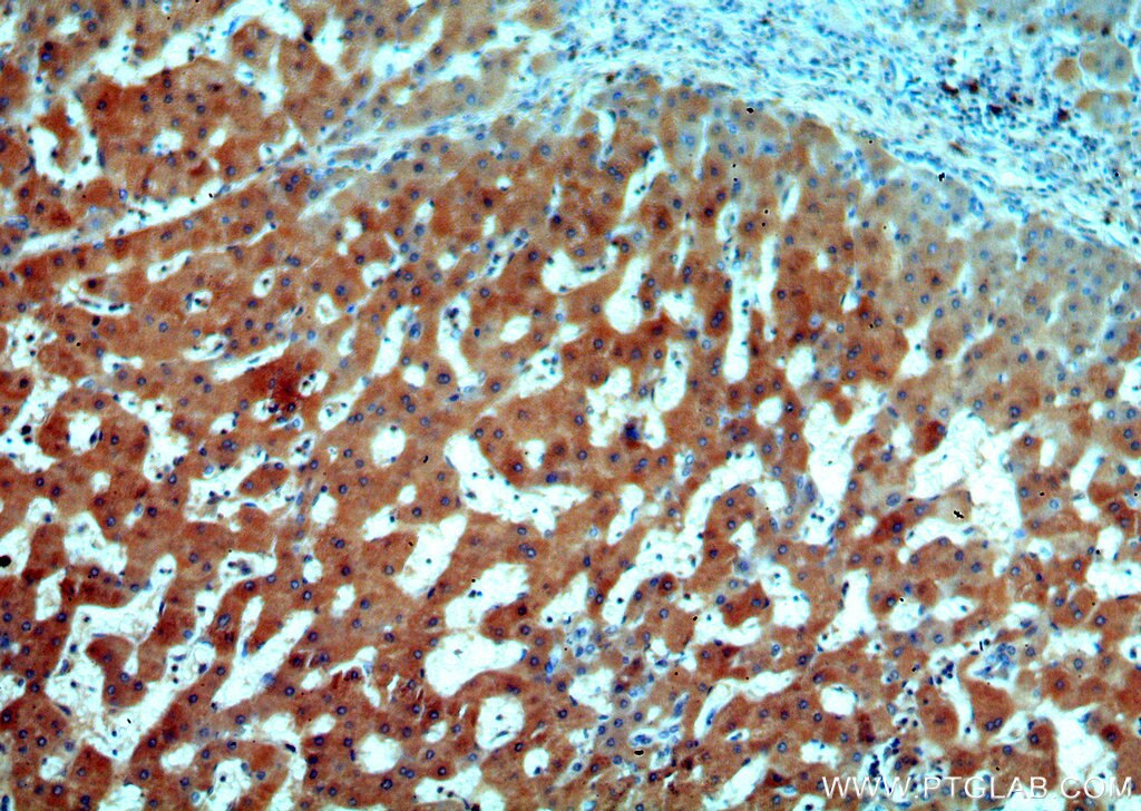 IHC staining of human hepatocirrhosis using 20181-1-AP