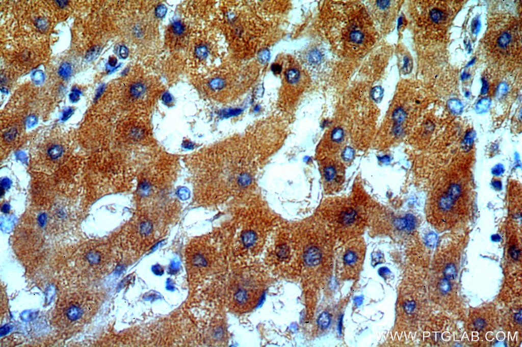 Immunohistochemistry (IHC) staining of human hepatocirrhosis tissue using ERp19 Polyclonal antibody (20181-1-AP)