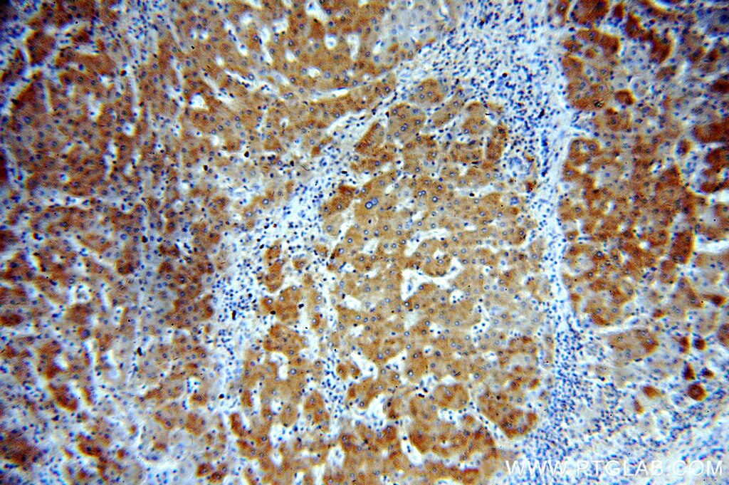 Immunohistochemistry (IHC) staining of human hepatocirrhosis tissue using ERp19 Polyclonal antibody (20181-1-AP)