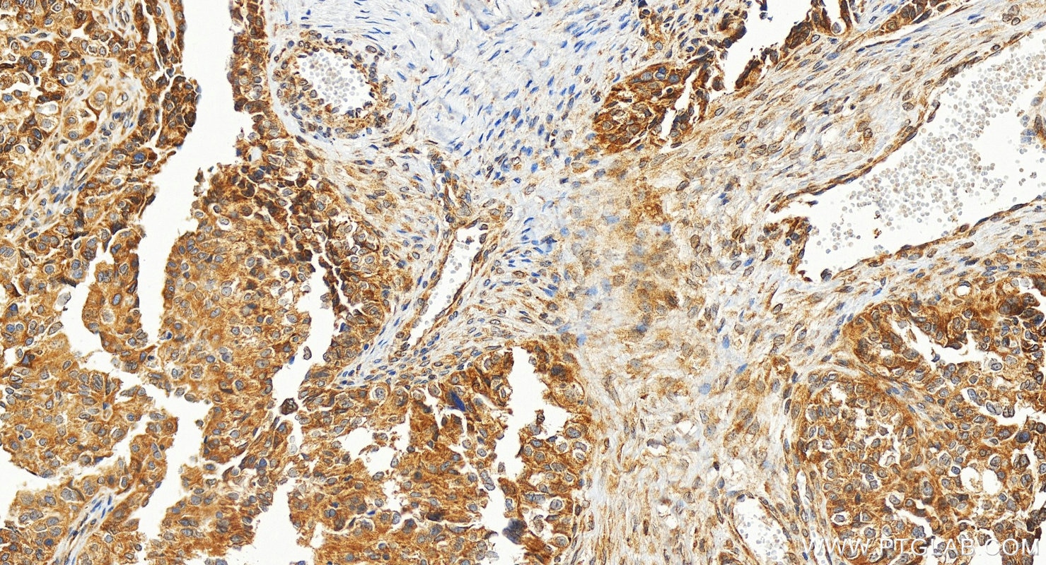 Immunohistochemistry (IHC) staining of human ovary cancer tissue using TXNDC15 Polyclonal antibody (32874-1-AP)
