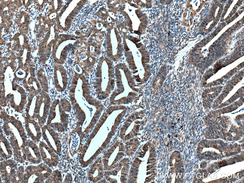 Immunohistochemistry (IHC) staining of human endometrial cancer tissue using TXNDC5 Polyclonal antibody (19834-1-AP)