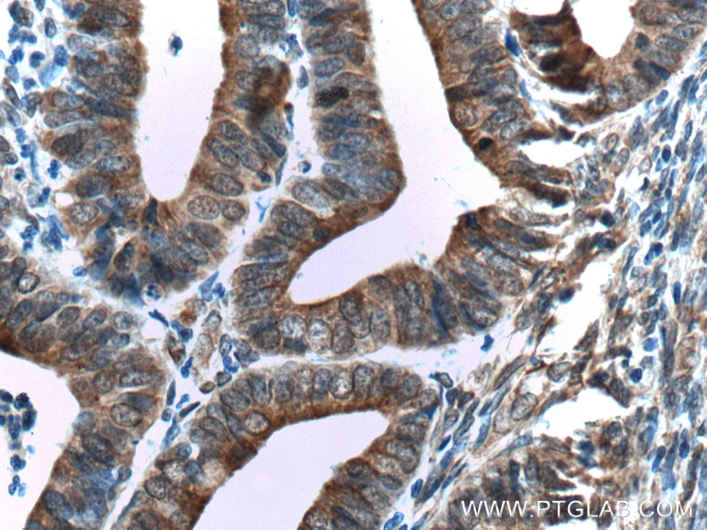 Immunohistochemistry (IHC) staining of human endometrial cancer tissue using TXNDC5 Polyclonal antibody (19834-1-AP)