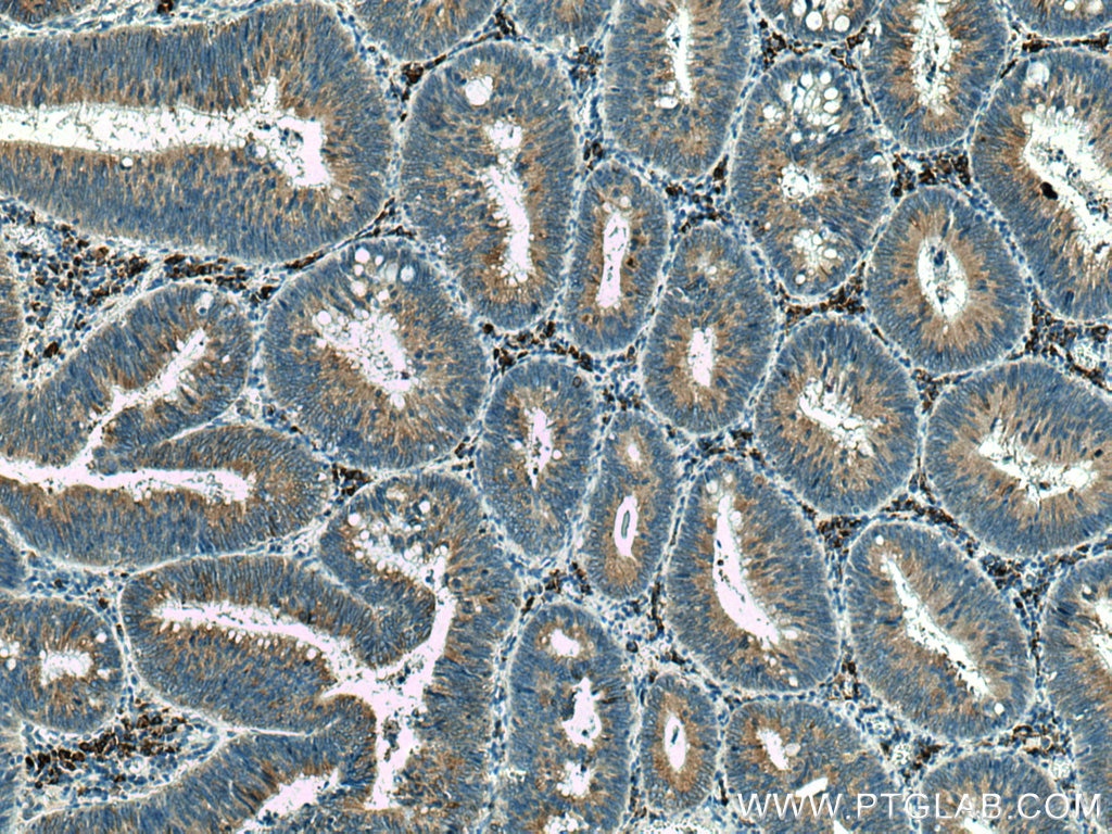 Immunohistochemistry (IHC) staining of human colon cancer tissue using TXNDC5 Polyclonal antibody (19834-1-AP)