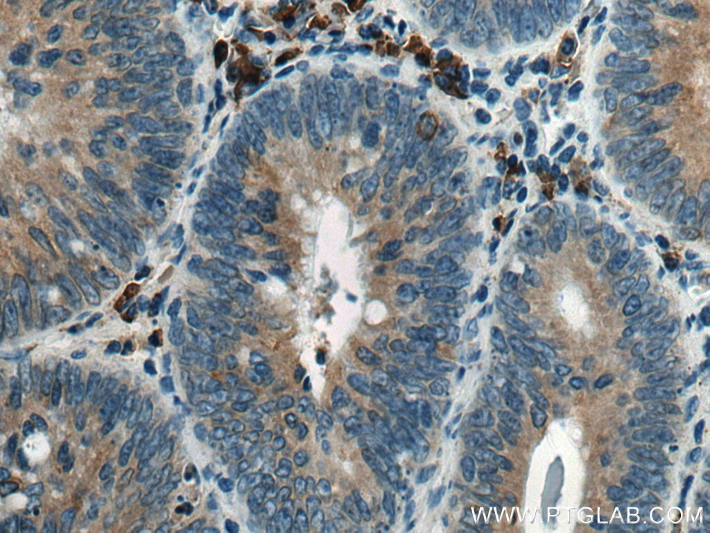 Immunohistochemistry (IHC) staining of human colon cancer tissue using TXNDC5 Polyclonal antibody (19834-1-AP)