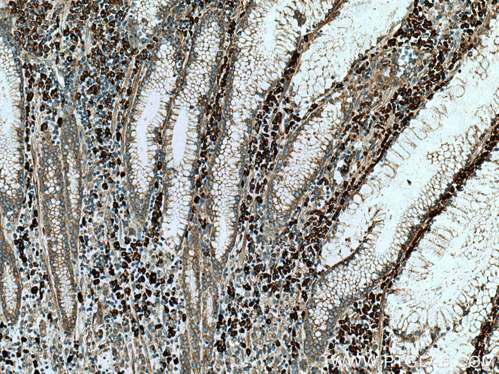 Immunohistochemistry (IHC) staining of human stomach cancer tissue using TXNDC5 Polyclonal antibody (19834-1-AP)