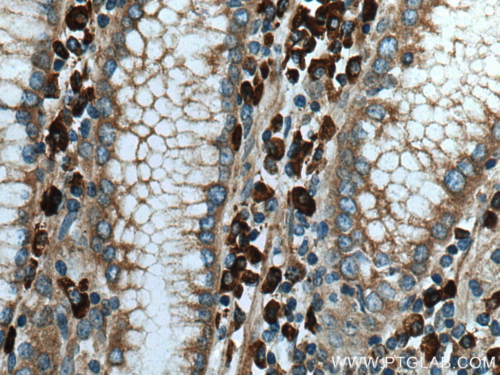 Immunohistochemistry (IHC) staining of human stomach cancer tissue using TXNDC5 Polyclonal antibody (19834-1-AP)