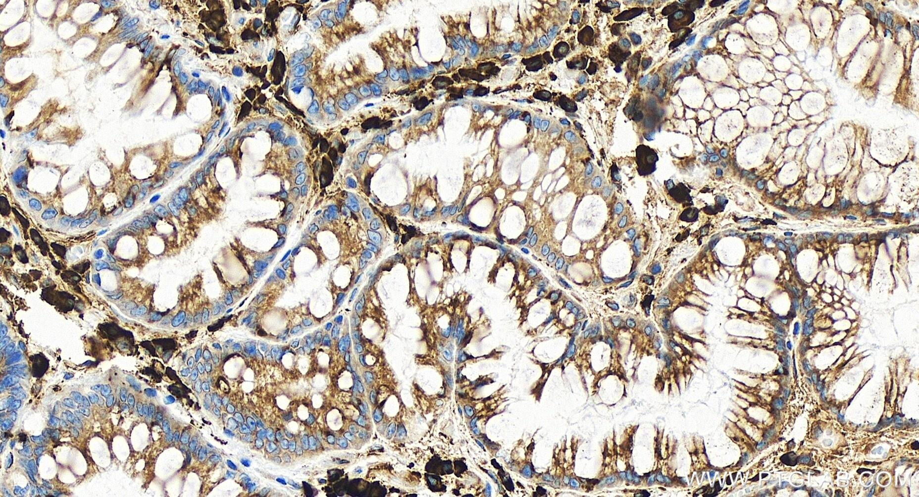 Immunohistochemistry (IHC) staining of human stomach cancer tissue using TXNDC5 Recombinant antibody (84756-5-RR)