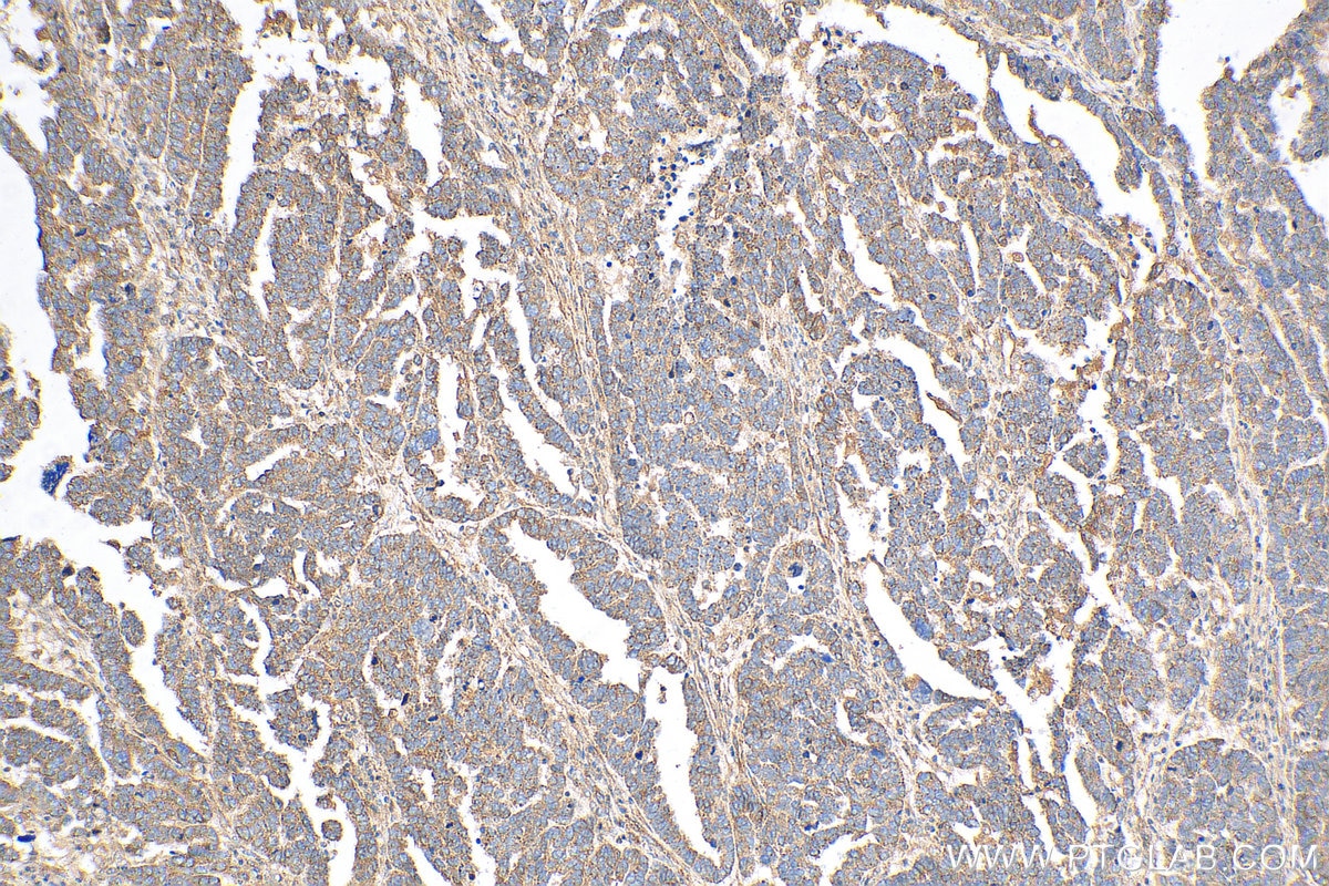 Immunohistochemistry (IHC) staining of human ovary tumor tissue using TXNIP Polyclonal antibody (18243-1-AP)