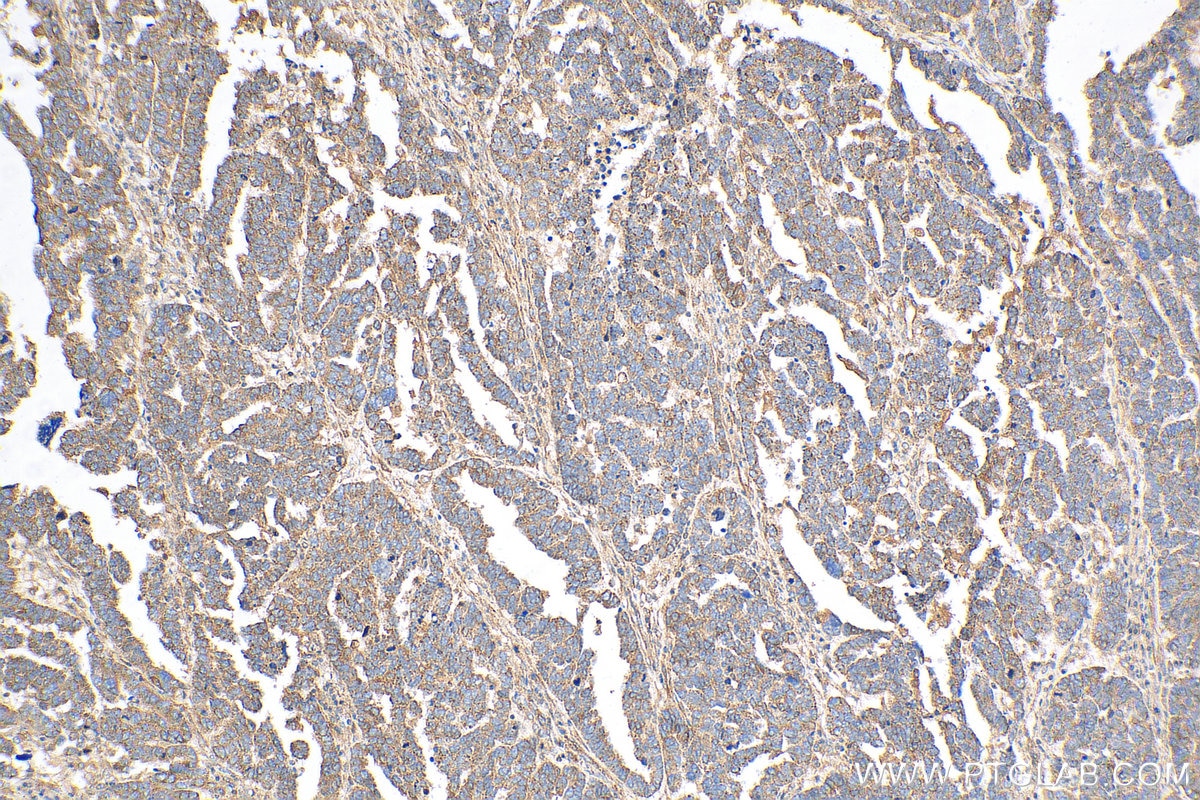 IHC staining of human ovary tumor using 18243-1-AP