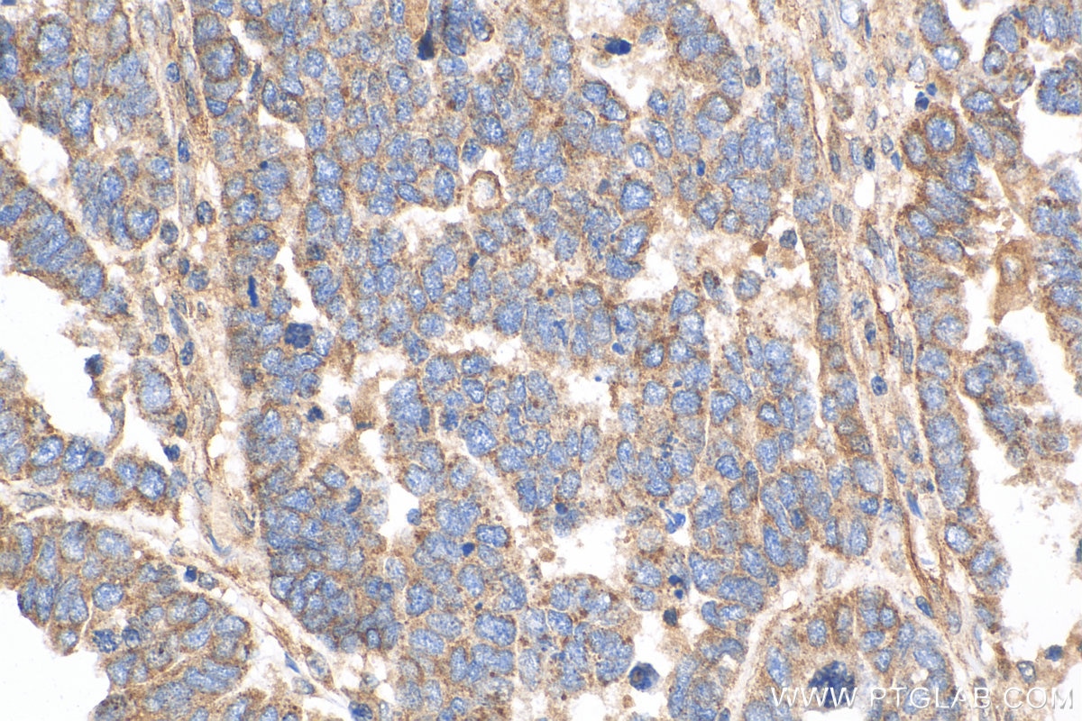 Immunohistochemistry (IHC) staining of human ovary tumor tissue using TXNIP Polyclonal antibody (18243-1-AP)