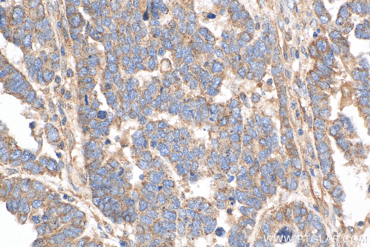 IHC staining of human ovary tumor using 18243-1-AP