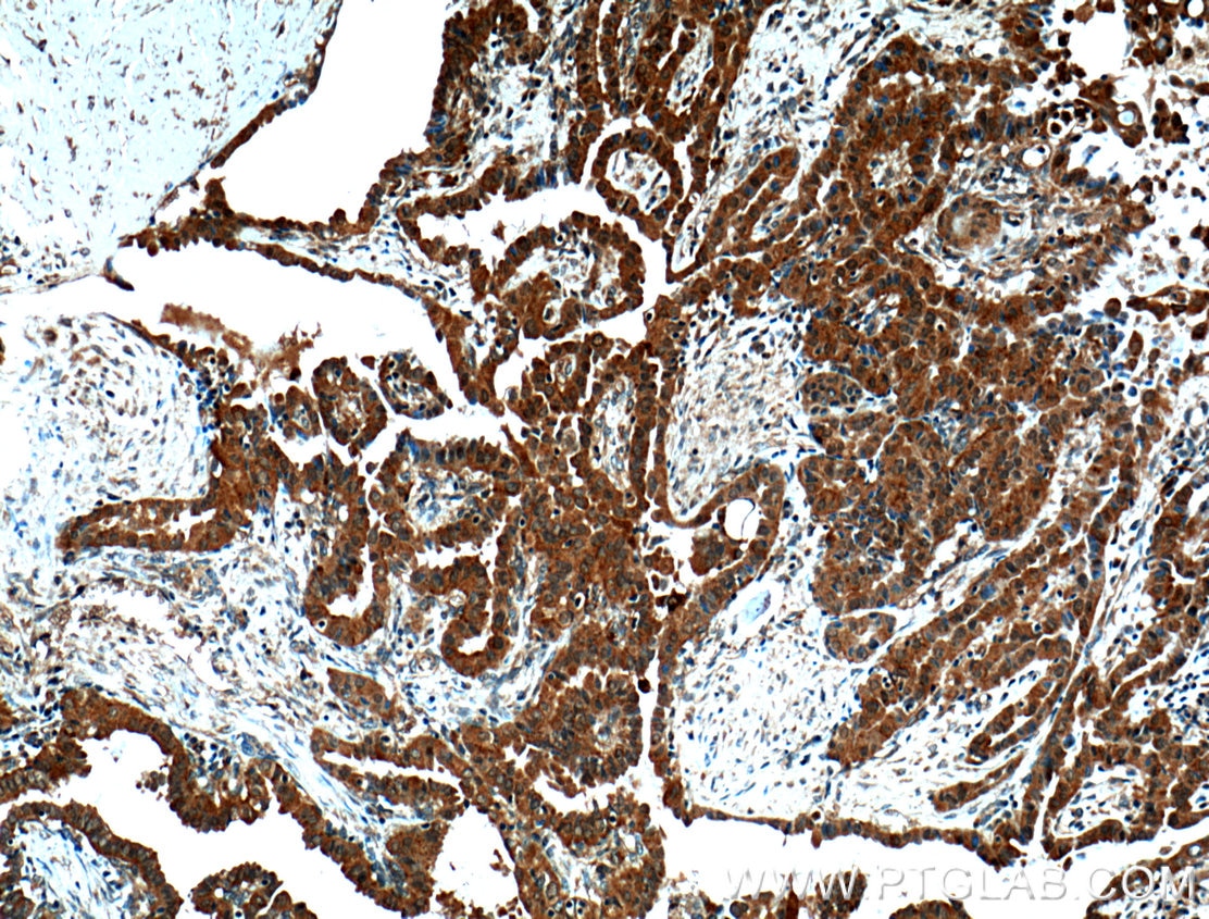 Immunohistochemistry (IHC) staining of human thyroid cancer tissue using TXNL1 Polyclonal antibody (15289-1-AP)