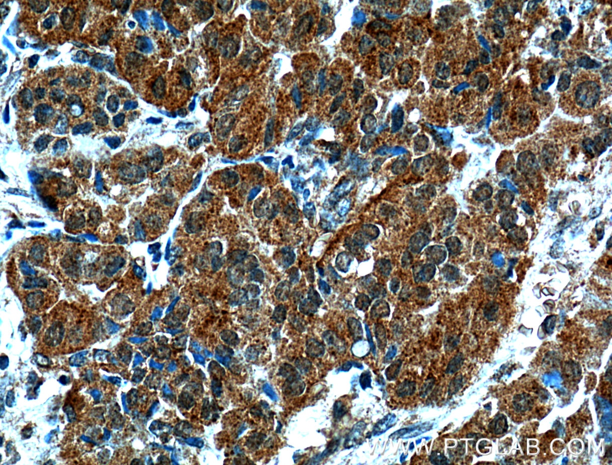 Immunohistochemistry (IHC) staining of human thyroid cancer tissue using TXNL1 Polyclonal antibody (15289-1-AP)