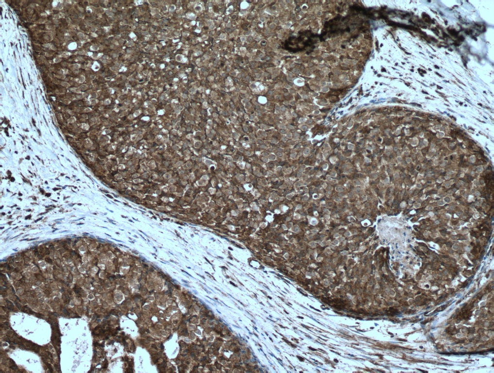 Immunohistochemistry (IHC) staining of human breast cancer tissue using TXNRD1 Polyclonal antibody (11117-1-AP)