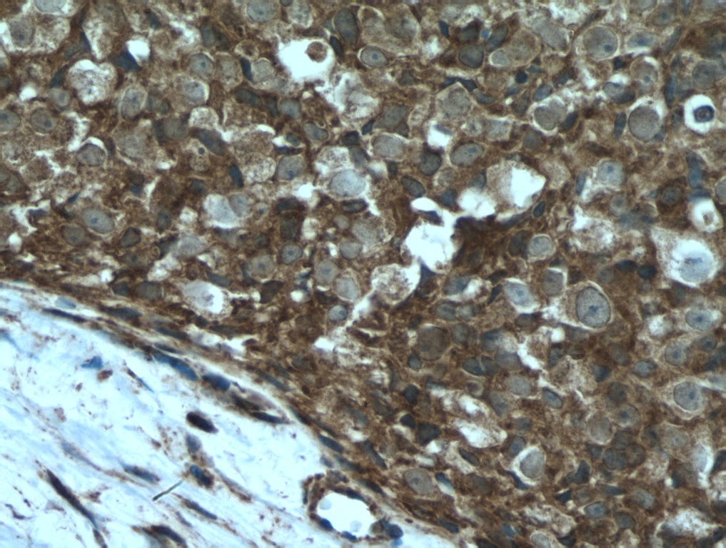 Immunohistochemistry (IHC) staining of human breast cancer tissue using TXNRD1 Polyclonal antibody (11117-1-AP)