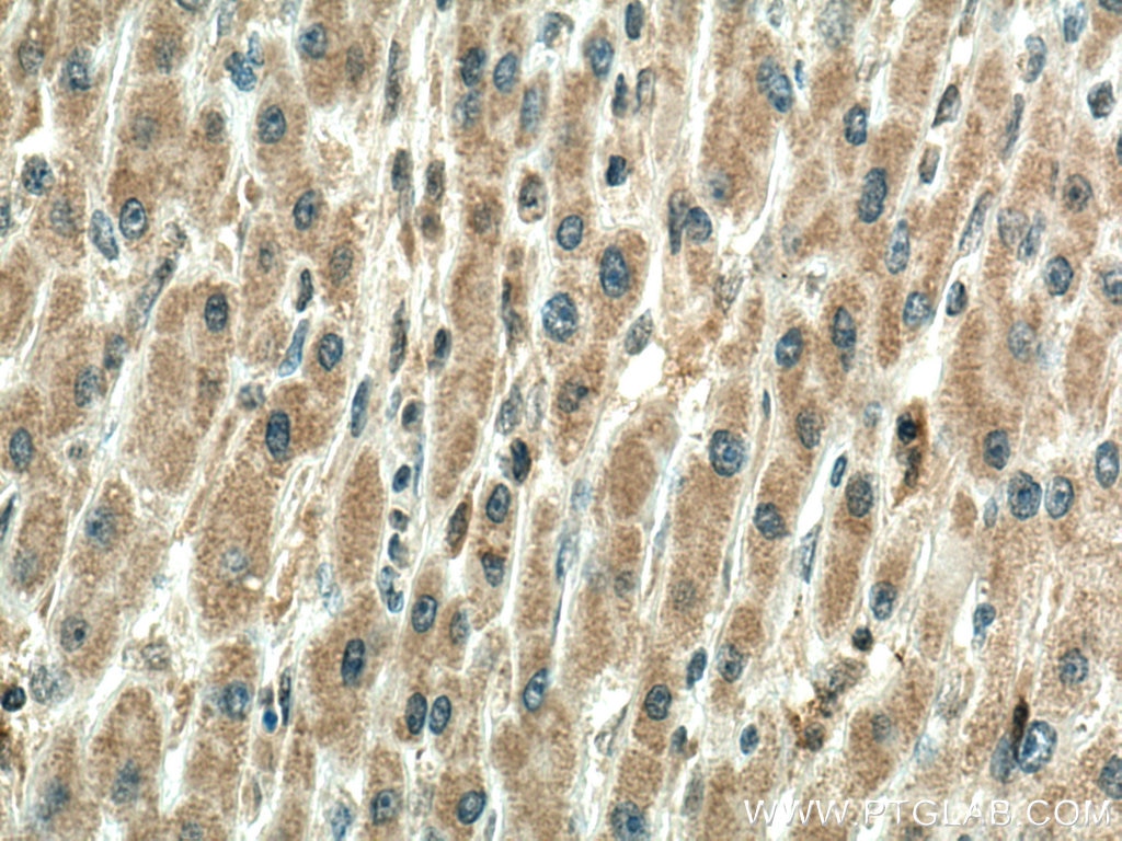 Immunohistochemistry (IHC) staining of human liver cancer tissue using TXNRD1 Monoclonal antibody (67728-1-Ig)