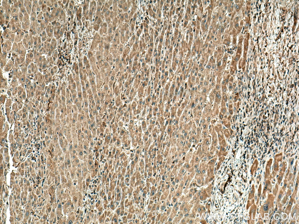 IHC staining of human liver cancer using 67728-1-Ig