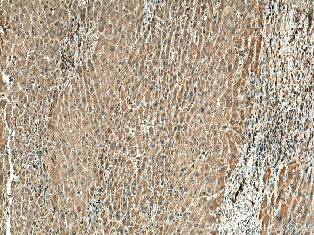 Immunohistochemistry (IHC) staining of human liver cancer tissue using TXNRD1 Monoclonal antibody (67728-1-Ig)