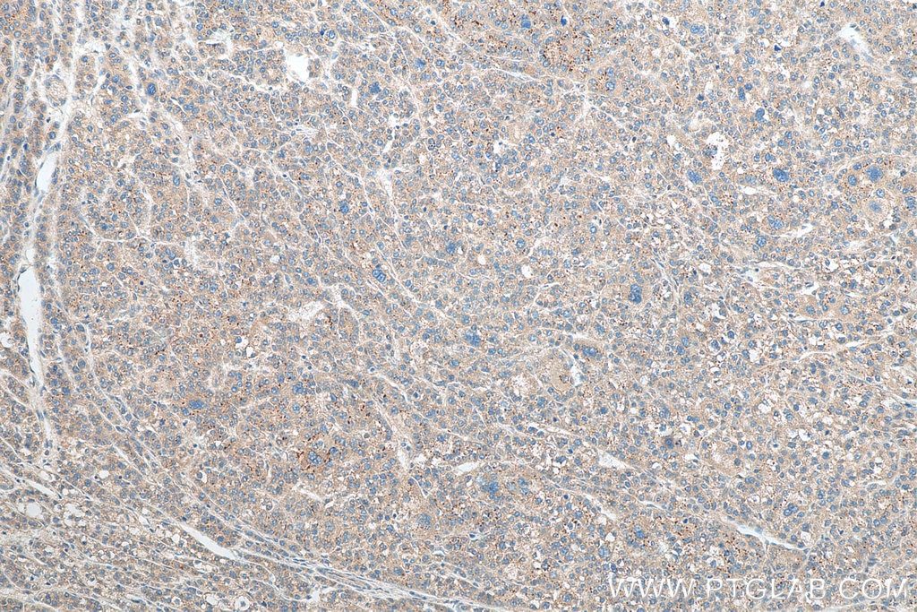 Immunohistochemistry (IHC) staining of human liver cancer tissue using TYK2 Polyclonal antibody (16412-1-AP)
