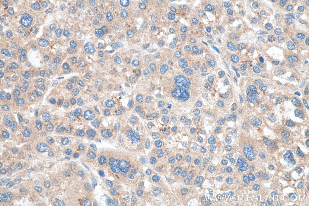 Immunohistochemistry (IHC) staining of human liver cancer tissue using TYK2 Polyclonal antibody (16412-1-AP)