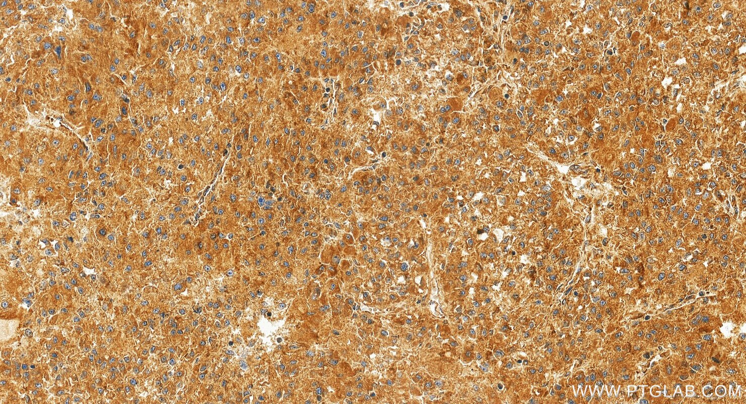 Immunohistochemistry (IHC) staining of Hepatocellular carcinoma tissue using TYK2 Polyclonal antibody (30838-1-AP)