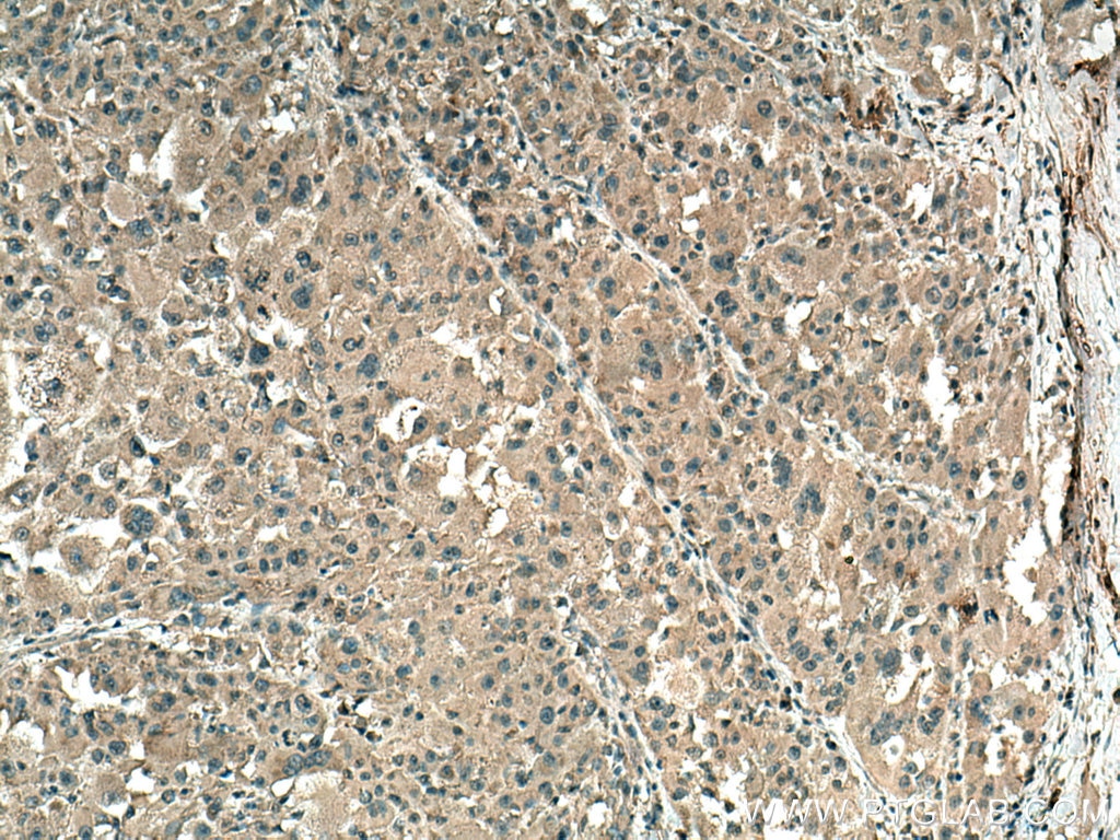 Immunohistochemistry (IHC) staining of human liver cancer tissue using TYK2 Monoclonal antibody (67411-1-Ig)