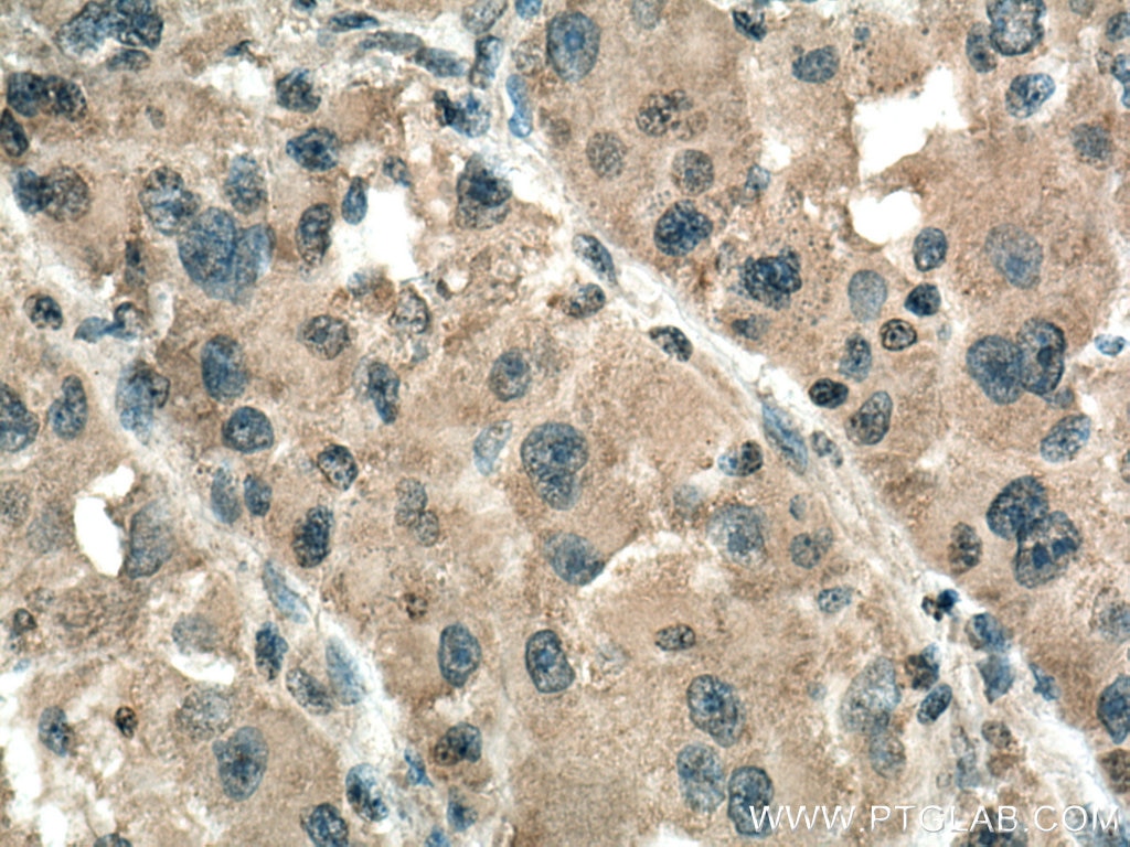 Immunohistochemistry (IHC) staining of human liver cancer tissue using TYK2 Monoclonal antibody (67411-1-Ig)