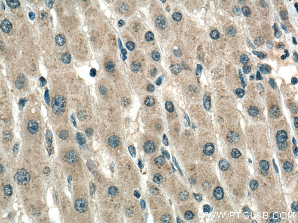 Immunohistochemistry (IHC) staining of human liver cancer tissue using TYK2 Monoclonal antibody (67411-1-Ig)