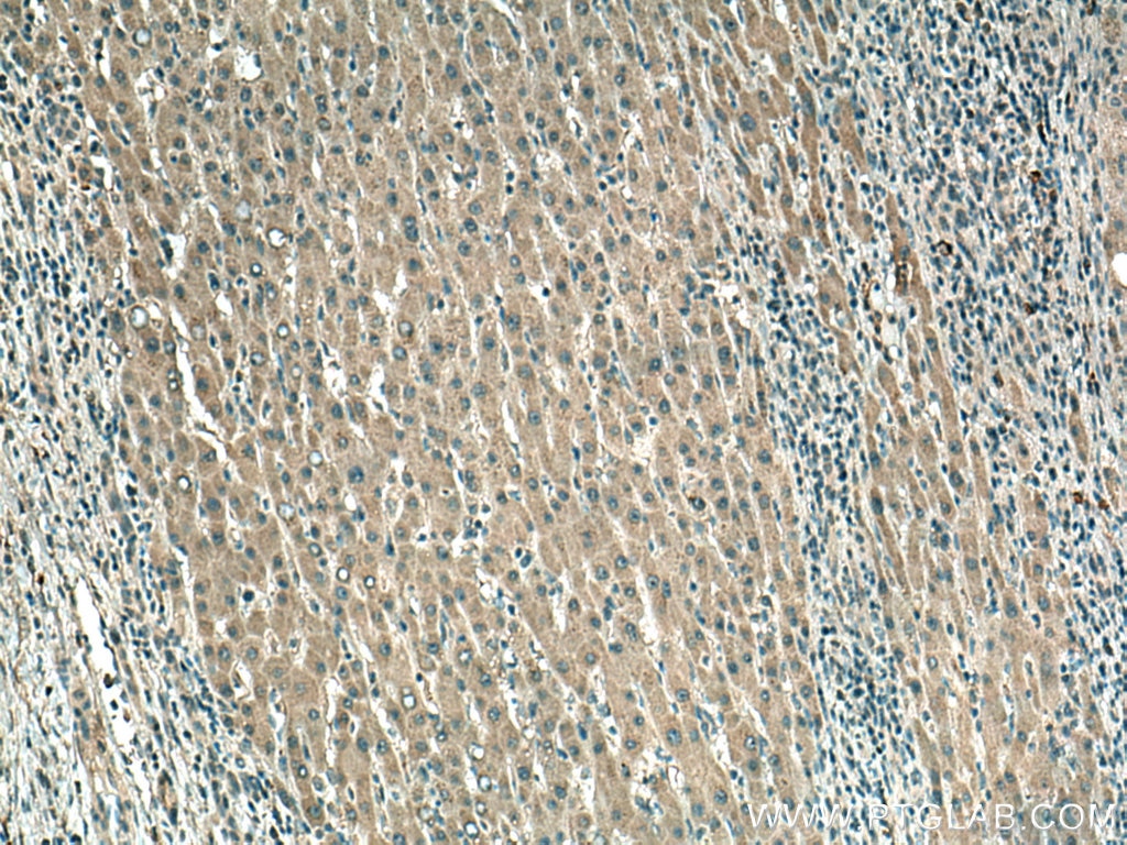 Immunohistochemistry (IHC) staining of human liver cancer tissue using TYK2 Monoclonal antibody (67411-1-Ig)