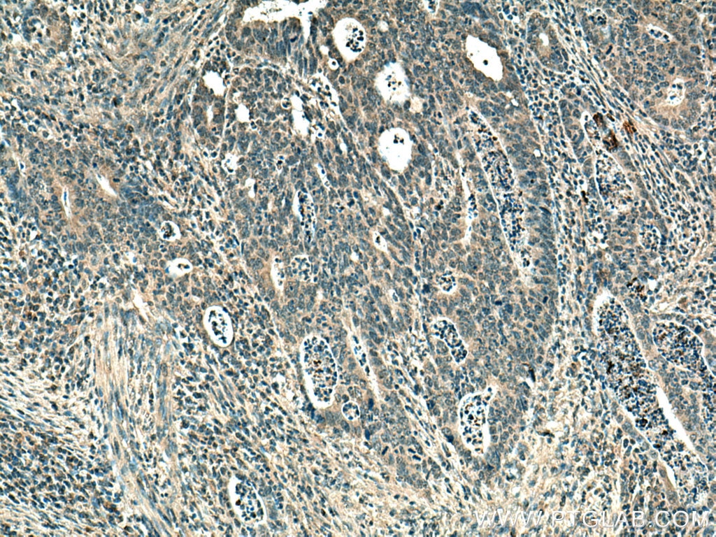 Immunohistochemistry (IHC) staining of human colon cancer tissue using TYK2 Monoclonal antibody (67411-1-Ig)