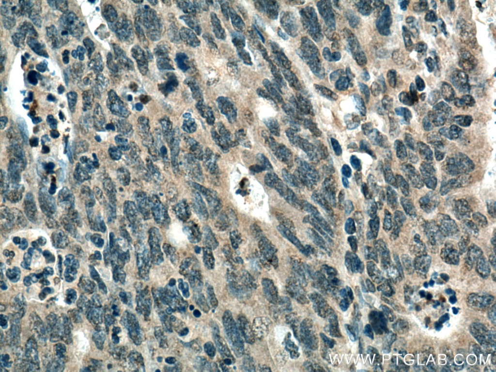 Immunohistochemistry (IHC) staining of human colon cancer tissue using TYK2 Monoclonal antibody (67411-1-Ig)