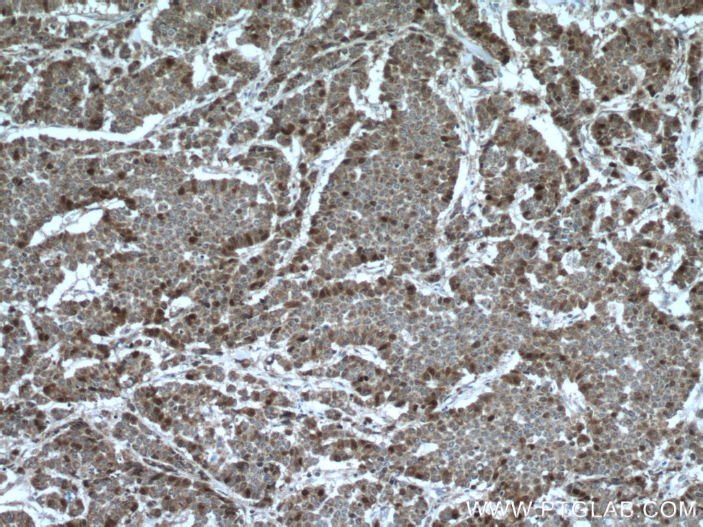 Immunohistochemistry (IHC) staining of human colon cancer tissue using Thymidylate synthase Polyclonal antibody (15047-1-AP)