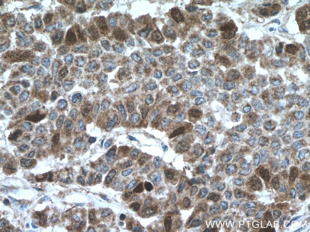 Immunohistochemistry (IHC) staining of human colon cancer tissue using Thymidylate synthase Polyclonal antibody (15047-1-AP)