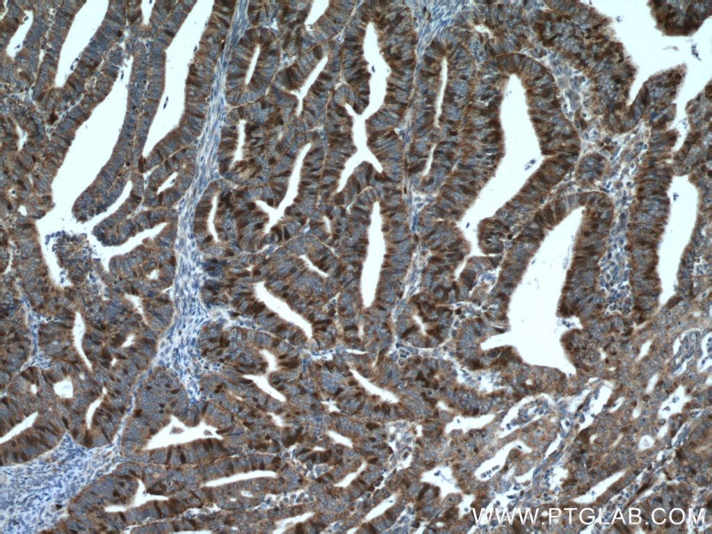 Immunohistochemistry (IHC) staining of human endometrial cancer tissue using Thymidylate synthase Polyclonal antibody (15047-1-AP)