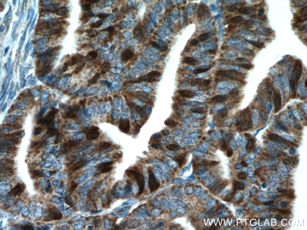 Immunohistochemistry (IHC) staining of human endometrial cancer tissue using Thymidylate synthase Polyclonal antibody (15047-1-AP)