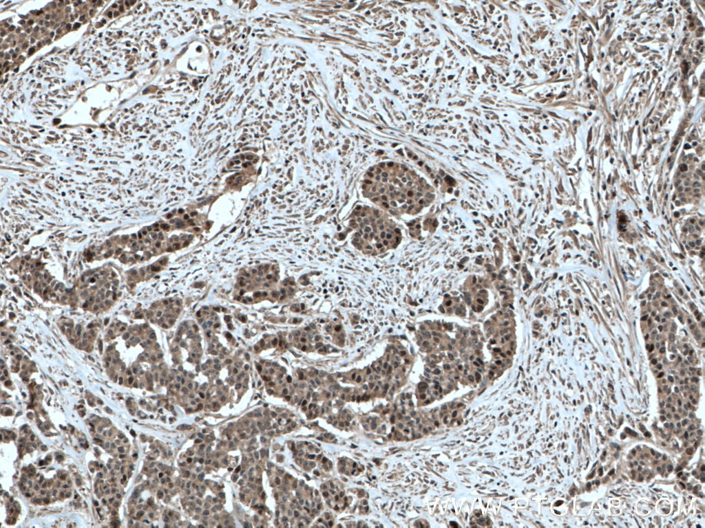 Immunohistochemistry (IHC) staining of human colon cancer tissue using TYMS Monoclonal antibody (66725-1-Ig)