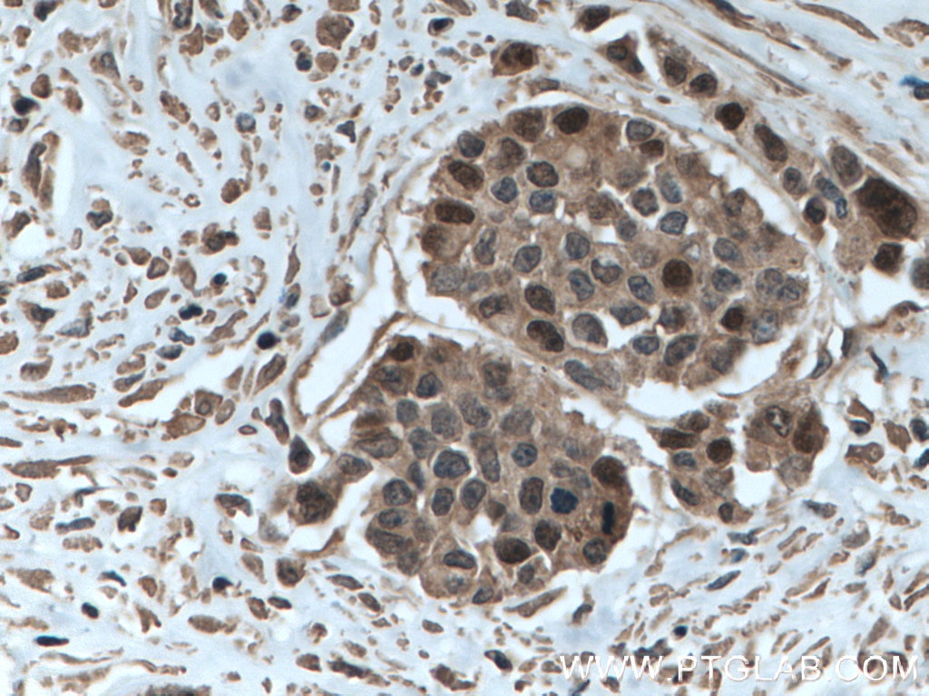 Immunohistochemistry (IHC) staining of human colon cancer tissue using TYMS Monoclonal antibody (66725-1-Ig)