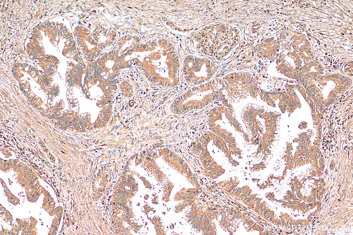Immunohistochemistry (IHC) staining of human pancreas cancer tissue using TYMS Monoclonal antibody (66725-1-Ig)