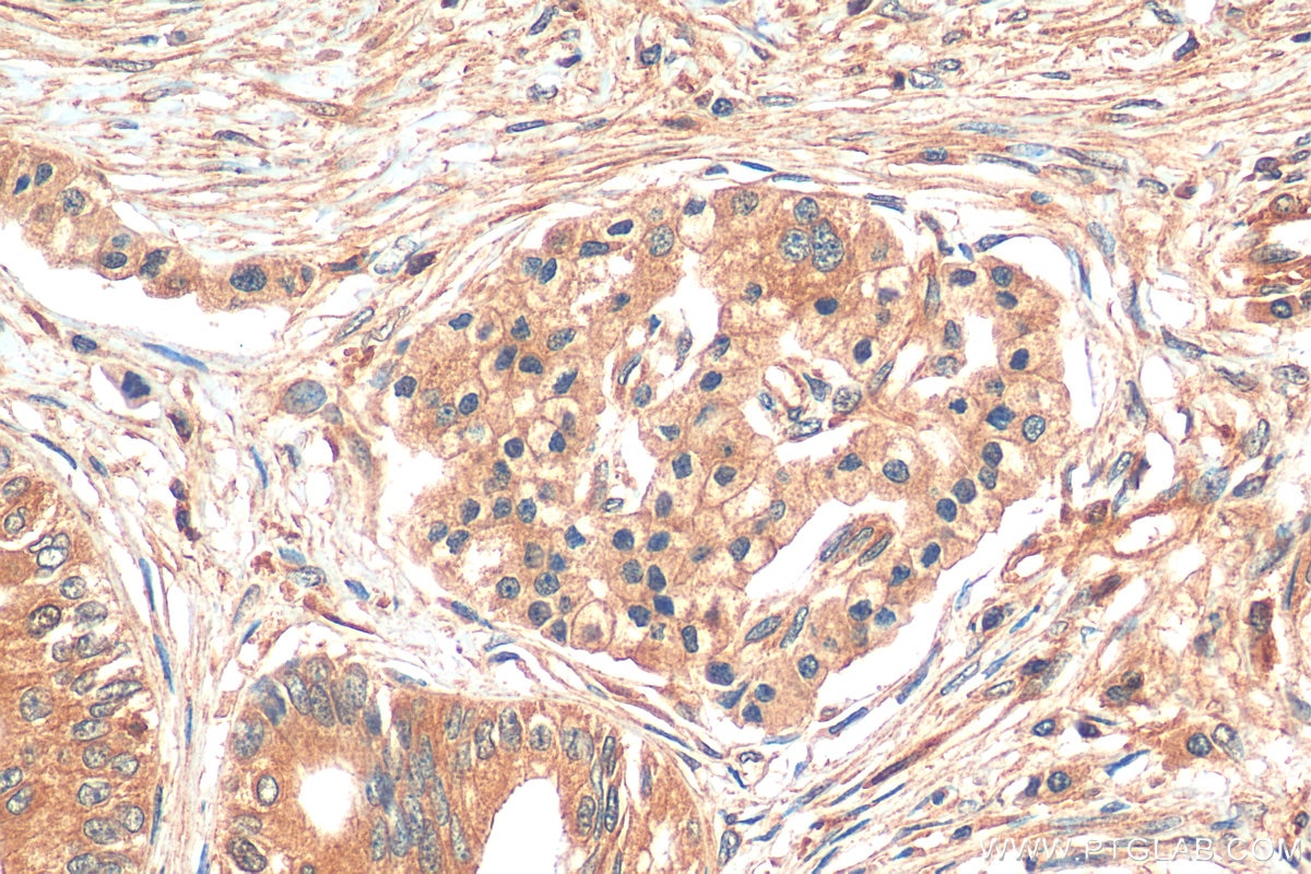 Immunohistochemistry (IHC) staining of human pancreas cancer tissue using TYMS Monoclonal antibody (66725-1-Ig)