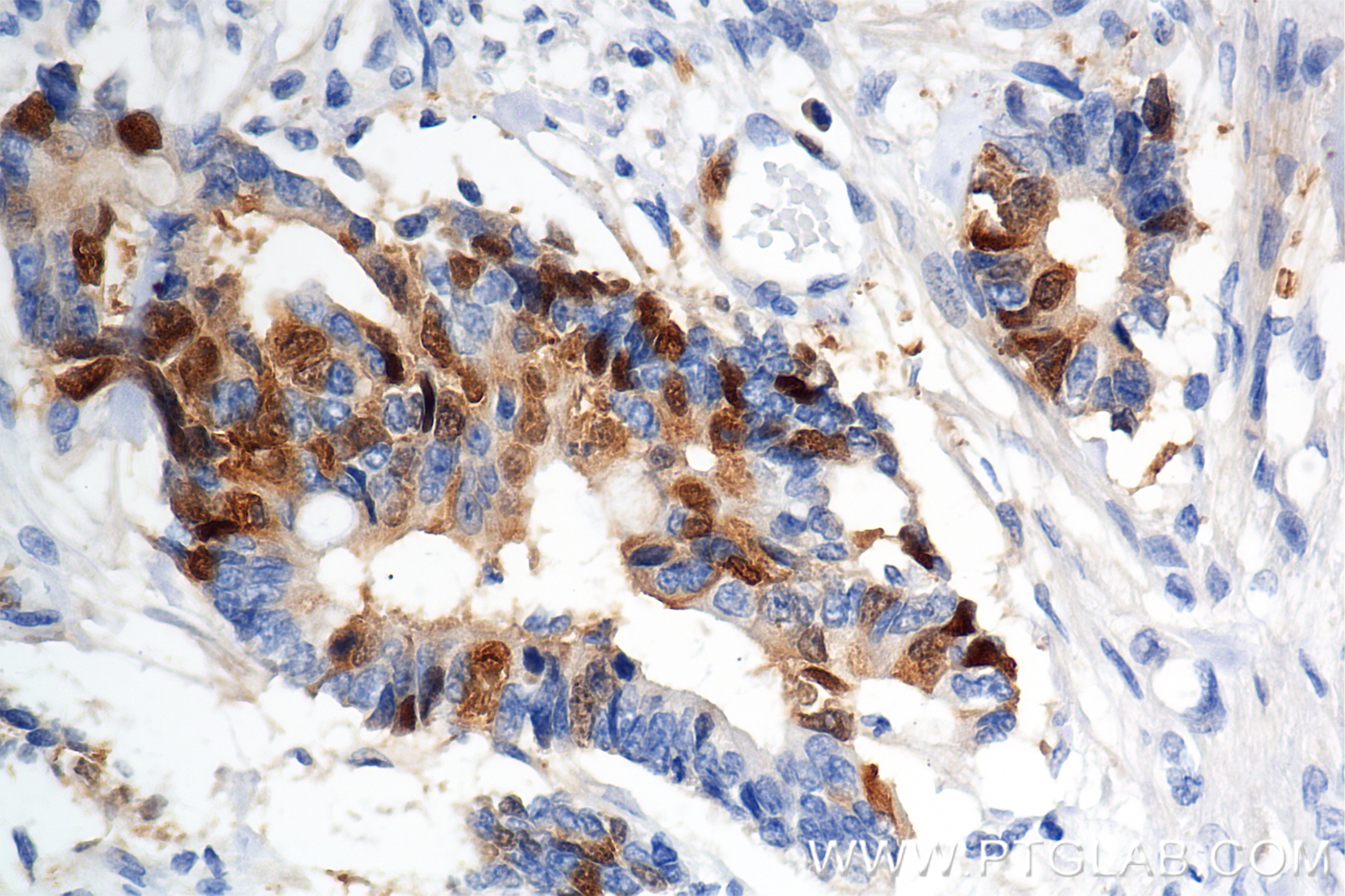 IHC staining of human rectal cancer using 86643-1-RR Immunohistochemistry (IHC) staining of human rectal cancer tissue using TYMS Recombinant monoclonal antibody (86643-1-RR)