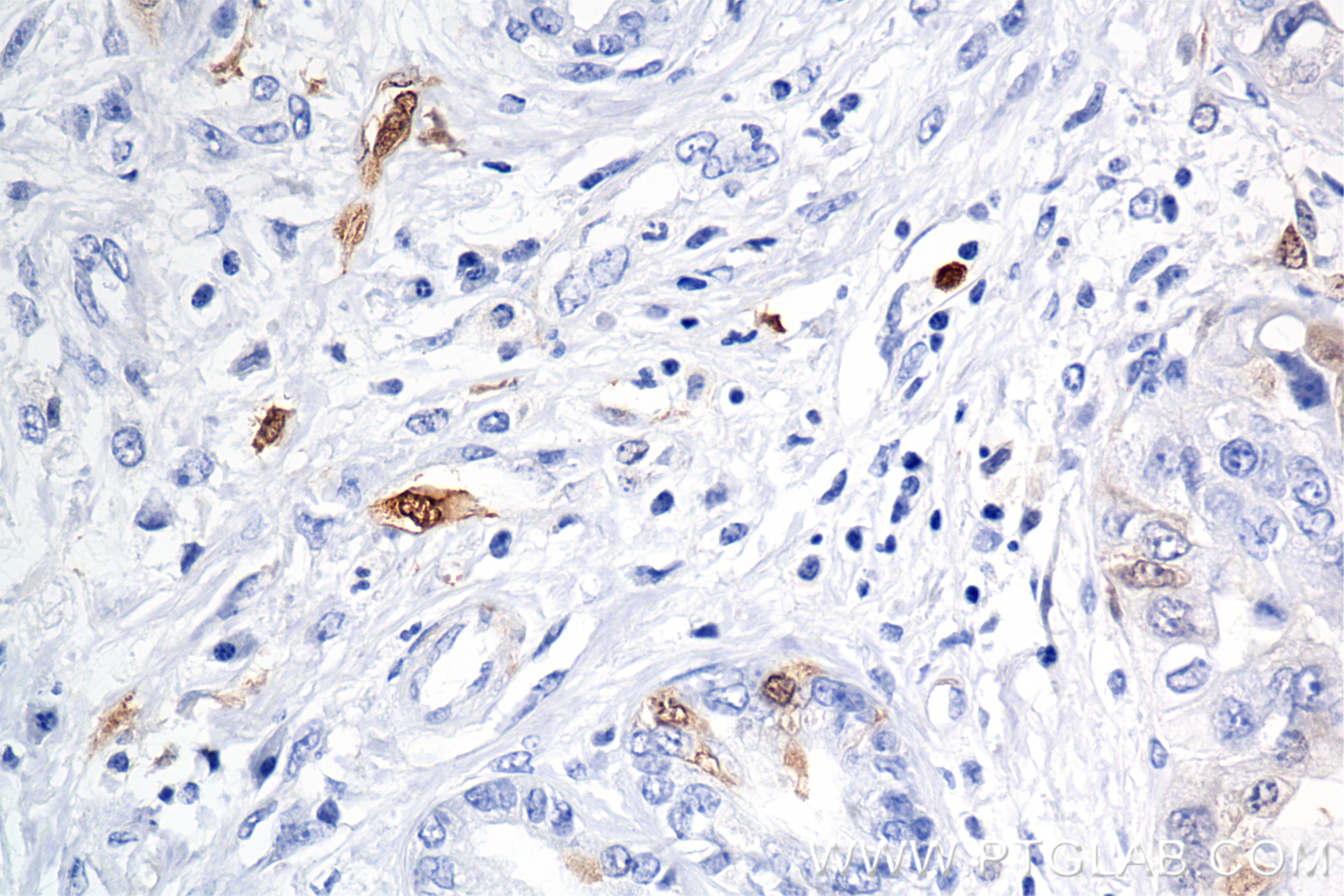 IHC staining of human pancreas cancer using 86643-1-RR Immunohistochemistry (IHC) staining of human pancreas cancer tissue using TYMS Recombinant monoclonal antibody (86643-1-RR)