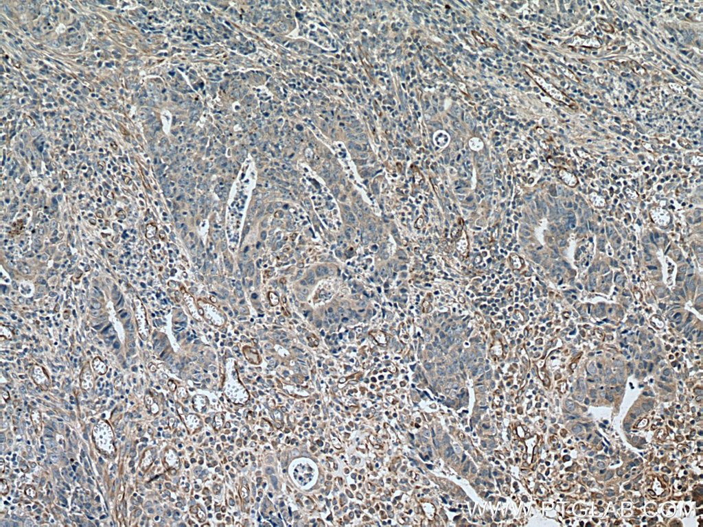 Immunohistochemistry (IHC) staining of human colon cancer tissue using TYRO3 Polyclonal antibody (28513-1-AP)