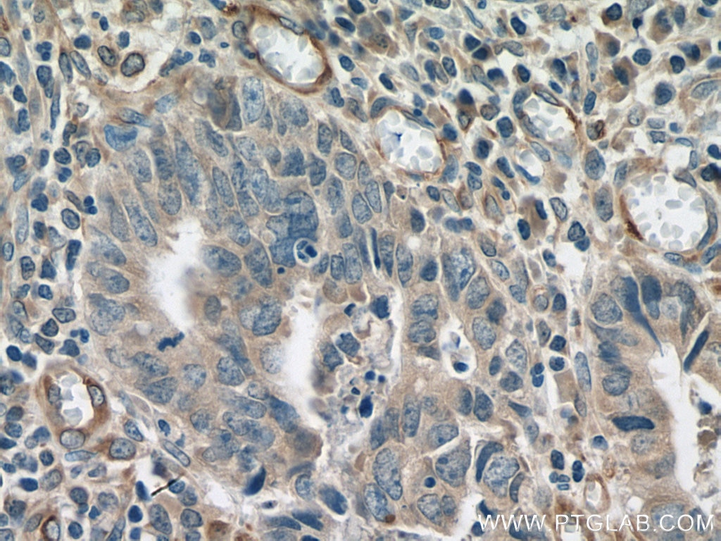 Immunohistochemistry (IHC) staining of human colon cancer tissue using TYRO3 Polyclonal antibody (28513-1-AP)