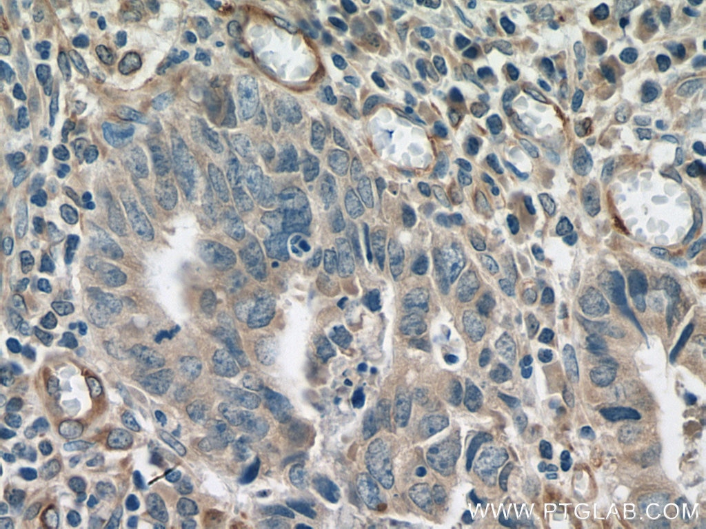 IHC staining of human colon cancer using 28513-1-AP