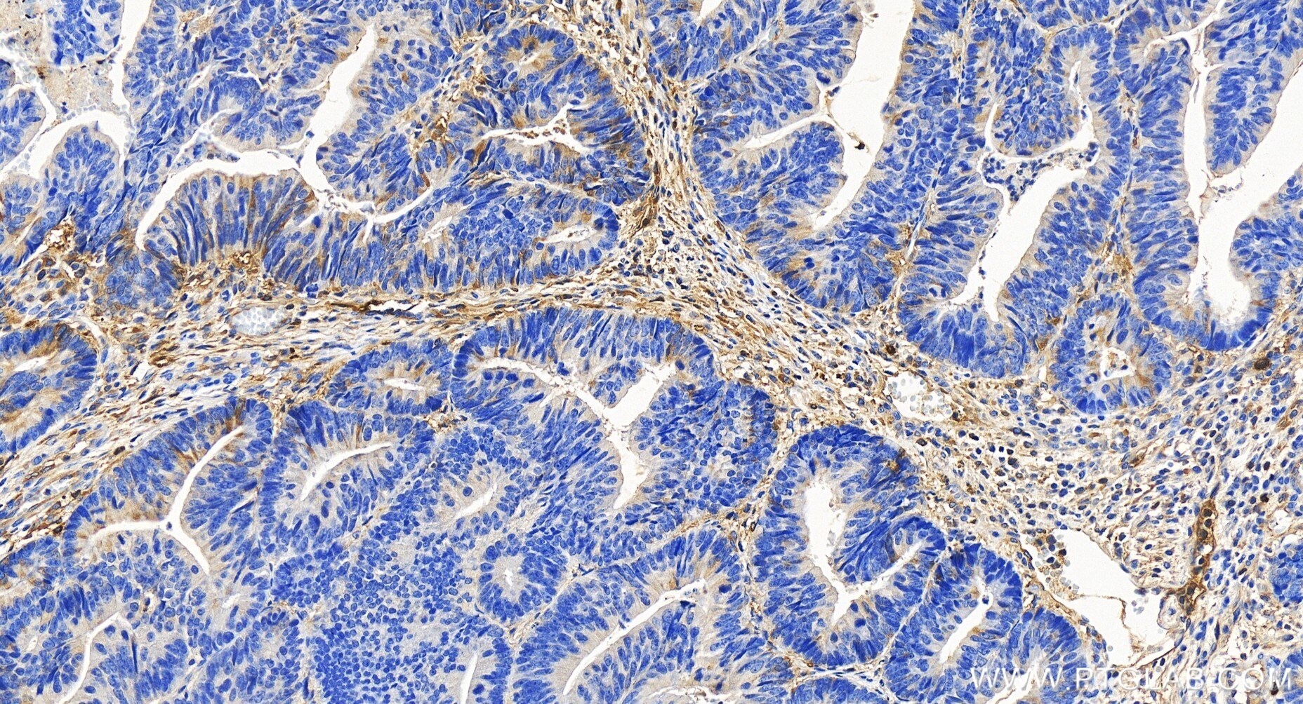Immunohistochemistry (IHC) staining of human colon cancer tissue using Tetranectin Recombinant antibody (85689-5-RR)